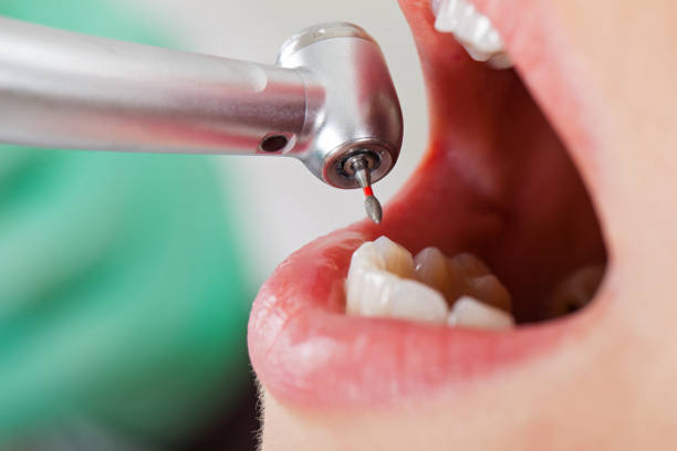 Tooth Infection Emergency Dentist in SD